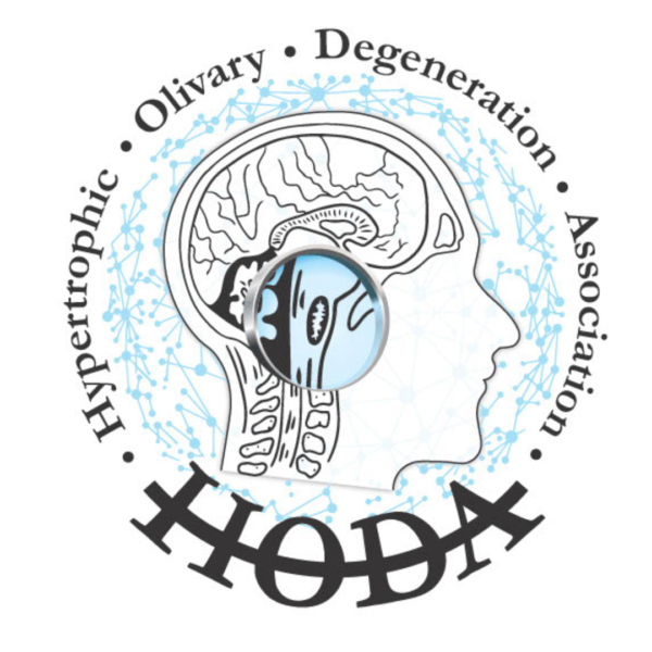 What is Hypertrophic Olivary Degeneration?